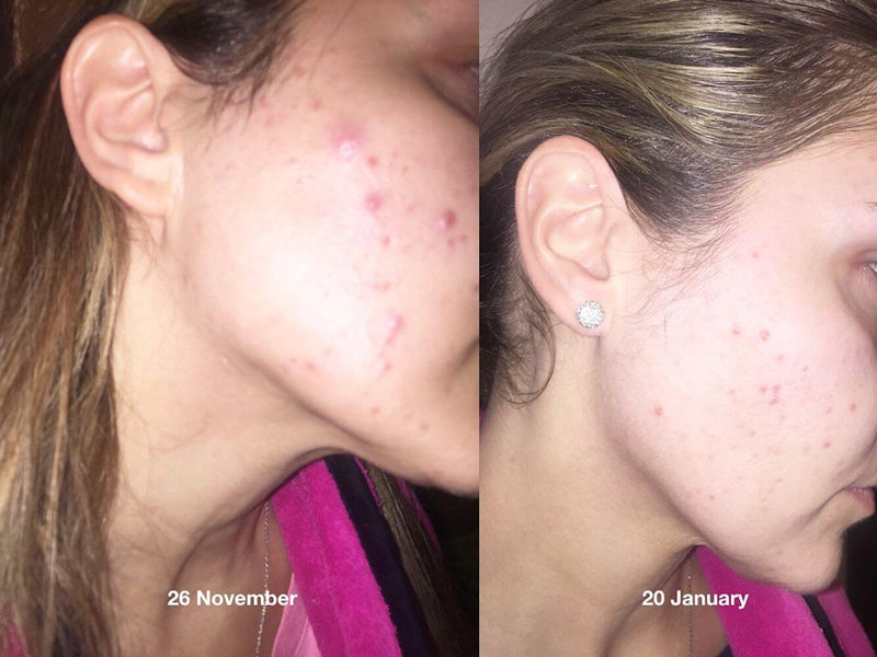 Acne & Blemish Skincare Routine - Mini - Starttech Online Market