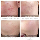 LANBENA Acne Removal Serum Salicylic Acid Anti-Acne Repair Fade Acne Spots Pimple Oil Control Cream Whitening Moisturizing Care - Starttech Online Market