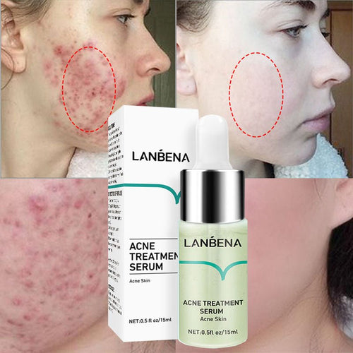 LANBENA Acne Removal Serum Salicylic Acid Anti-Acne Repair Fade Acne Spots Pimple Oil Control Cream Whitening Moisturizing Care - Starttech Online Market